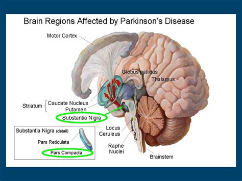 area of brain affected by parkinson's disease